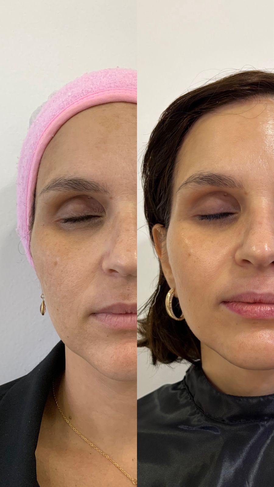 Rejuvenescimento facial