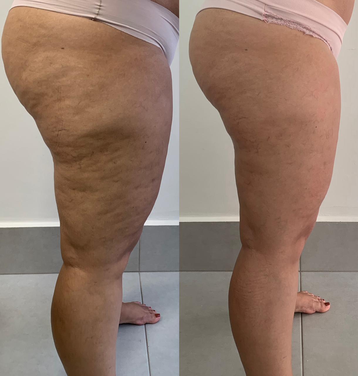 Tratamento para celulite